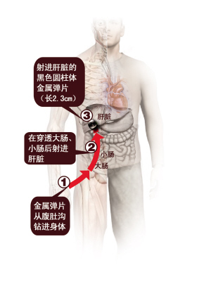 自制炸弹酿悲剧 男子遭弹片钻进肝脏18天被救活