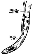 食管癌切除术