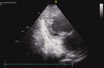 心衰查因：竟是心肌致密化不全！