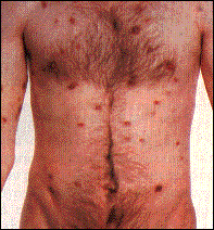 艾滋病卡波氏肉瘤