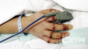 37岁女工离奇铊中毒昏迷27天