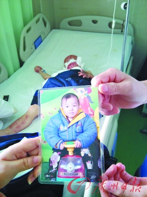家中失火致3岁男孩烧成重伤 连续抢救3周保性命