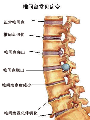 中西医结合 治疗颈椎病