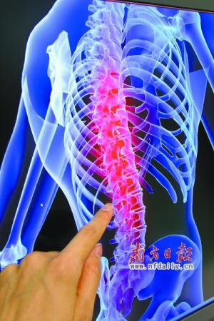 深圳：100个青少年6个脊柱侧弯 警惕孩子弯腰现剃刀背
