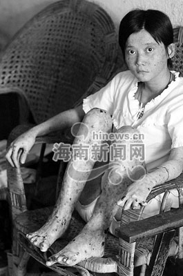 24岁女孩患怪病全身长满黑水疱手指烂掉