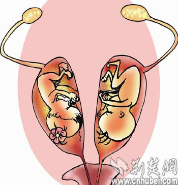 双子宫孕妇产下龙凤胎 发生率仅百万分之一