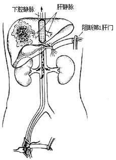 无血肝切除术