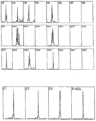 CML病人TCR Vβ21寡克隆T细胞及其CDR3序列特点