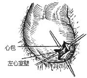 心包切除术