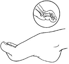 伸（足母）长肌腱转移术