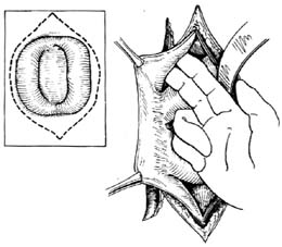 双口式肠瘘闭合术