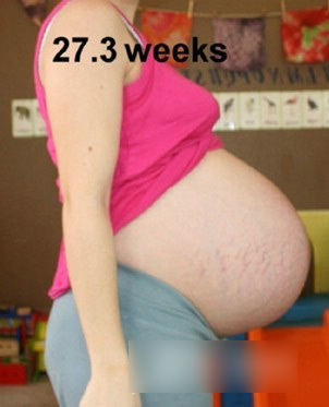 三胞胎孕妇怀孕全过程