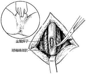 尿道狭窄修复术