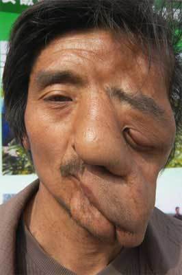 全球最恐怖的67种怪病