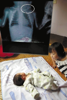 女婴刚出生四天锁骨骨折 医生称能自行愈合