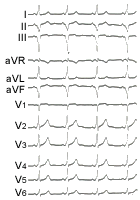 射频消融位于冠状静脉窦憩室处的后间隔房室旁路