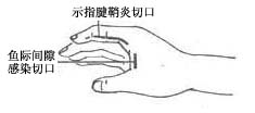 手掌深部间隙感染