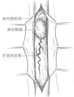 脊髓外硬脊膜内肿瘤切除术