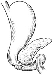 环状胰手术