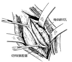 腰骶段脊椎结核病灶清除术