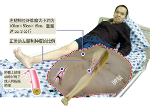 男子腿上肿瘤生长15年重达100余斤