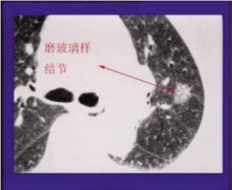 临床表现作疑诊，辅助检查来验证