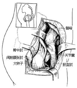 髋关节融合术