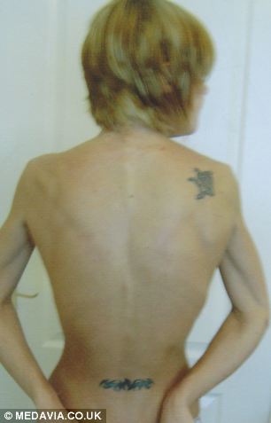 英女子过度缩胸患厌食症