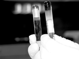 广东发现一罕见病例 血液抽到试管凝固成啫哩