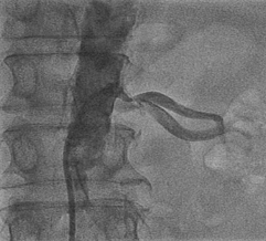 CIT-2005肾动脉介入演示病例