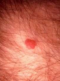 艾滋病皮肤病变