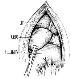 胆囊十二指肠吻合术