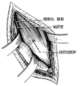 胸腰段脊椎结核病灶清除术