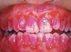 牙周炎——不可忽视的糖尿病并发症