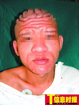 19岁小伙患骨膜增生厚皮症 面容比母亲还显苍老