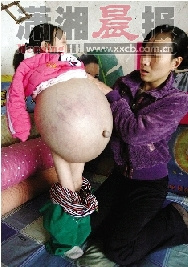女童肚子大过孕妇今日进京检查