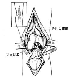 膝关节加压融合术
