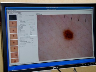 IDF：Intel展示'DermFind'感测技术 普通数码相机可为皮肤癌作初步诊断