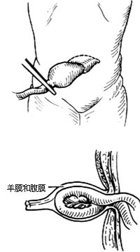 脐疝修复术