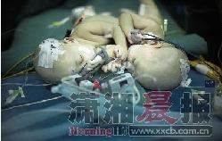 湖南联体女婴43天身心相连 巧手医生5小时分离