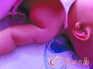 女婴打卡介苗后身体溃烂 专家诊断属预防接种异常反应