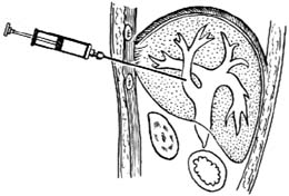 经皮肝穿刺胆道造影及引流术