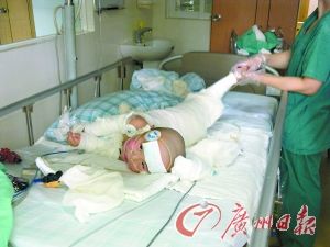 男童不慎掉入开水桶中一分钟