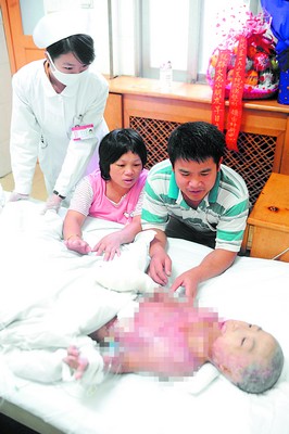 男子为救养子四次从自己身上取皮
