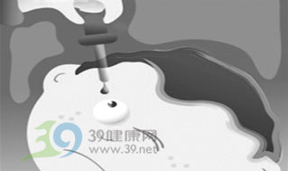 眼药水治疗近视有效吗？
