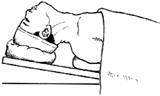 甲状腺次全切除术