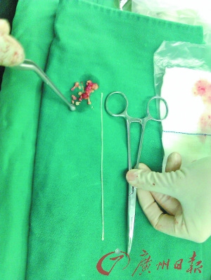 壮年小伙瘫卧床上 颅内取出25cm长虫