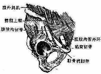 腹股沟疝