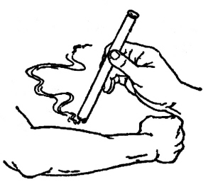 面瘫可用热敏灸（下）