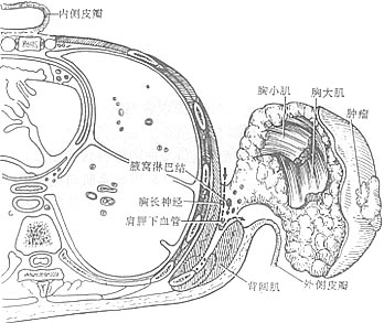 乳癌手术